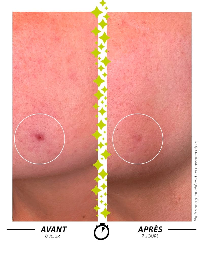 Garancia Sérum L'ELIXIR DU MARABOUT : Comparatif avant/après en 7 jours montrant l'efficacité d'un soin Garancia sur une imperfection cutanée ciblée. La peau est visiblement plus nette et le relief cutané lissé.