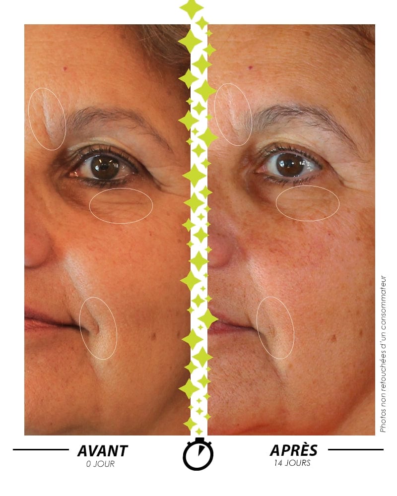 Laboratoire Garancia Anti-Âge & Anti-Rides [ ÉTOILE du jour ] : Résultat clinique avant/après 14 jours : réduction visible des rides et ridules sur le visage. Des cercles blancs mettent en évidence l'amélioration de la fermeté et du lissage de la peau.