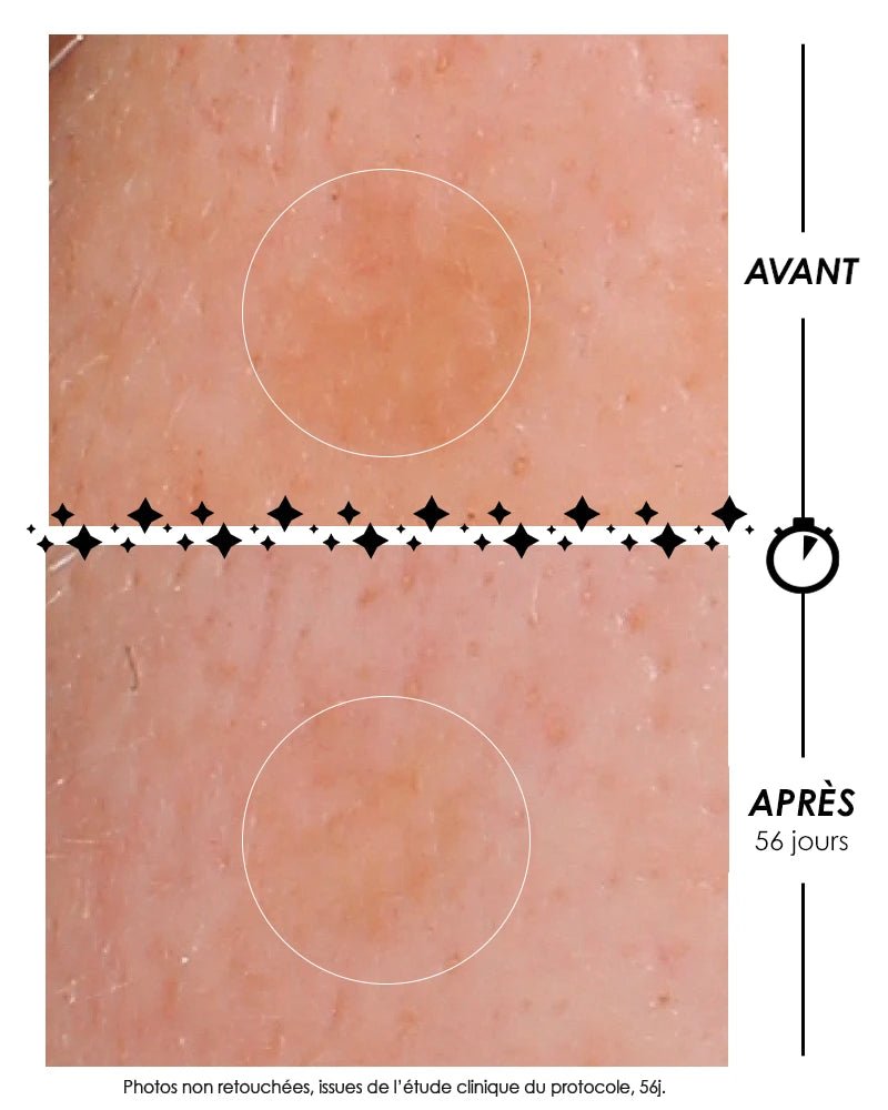 Photographies macroscopiques comparatives avant/après de L'Eclair de lune La Foudroyante : réduction de l'intensité d'une tache pigmentaire sur la peau après 56 jours de protocole clinique Garancia. Photos non retouchées.