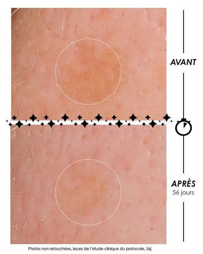 Photographies macroscopiques comparatives avant/après de L'Eclair de lune La Foudroyante : réduction de l'intensité d'une tache pigmentaire sur la peau après 56 jours de protocole clinique Garancia. Photos non retouchées.
